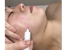 シミケア機器で唯一、特許を取得している機器での施術です。