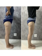 ドゥーソル 谷町四丁目店(due sole)/脂肪冷却/頑固な太ももの脂肪に