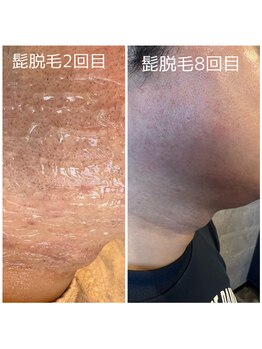 アレーズ(ALAISE)/髭脱毛before & after