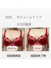 東広島西条整骨院/30代　バストアップ実績