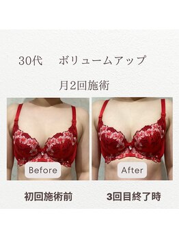東広島西条整骨院/30代　バストアップ実績