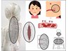 【わき腹、口唇のできもの】肩こりや背中の血行不良が原因で「湿熱」が発生