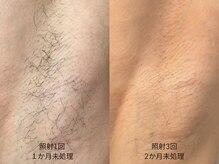 スキンラウンジ(SKIN LOUNGE)/圧倒的効果｜LED脱毛