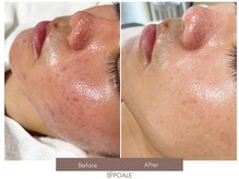 ポアレ 高崎店(POALE)/毛穴ケア症例【群馬/高崎】