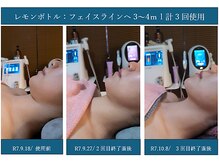 エステサロン☆さいとうの雰囲気（プラズマ照射後のレモンボトル導入&リフトを是非ご体験ください）