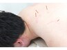 【頑固な首肩コリ・肩甲骨の重さに】深部にアプローチ◎深層筋鍼＋全身ほぐし