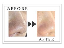 アルゴ 志免店(ALGO)/いちご鼻卒業