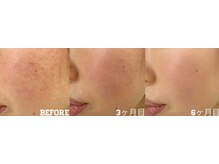 肌荒れでお悩みな方もお任せください！数々の実績があります！