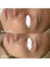 ホワイトアクア 中目黒店(WHITE AQUA)/ララピール/シワ改善/中目黒