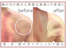 アメリオレ 三鷹店(AMELIORER)/腕のこり辛さに肩こり専用カッサ