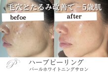 パールホワイトニング