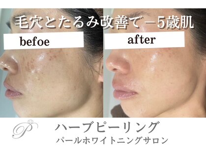 パールホワイトニングの写真