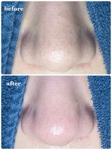 サロン ド ラム/【毛穴改善コース】1回目の効果