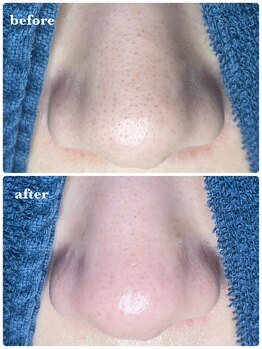 サロン ド ラム/【毛穴改善コース】1回目の効果