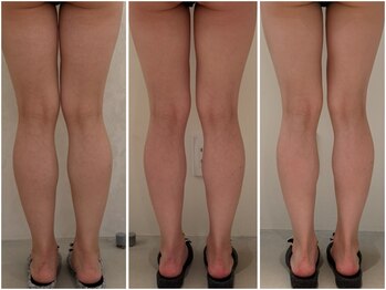 カレンジェビューティー(CarengeBeauty)/下半身ダイエット