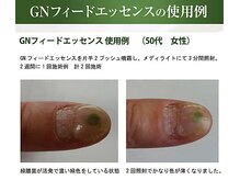 GNフィードエッセンスで緑のう菌を除去してジェルネイル可能