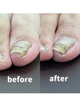 小田急相模原巻き爪矯正センター/矯正前後の写真