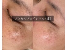 ル シーニュ/プロセルフェイシャル×2回