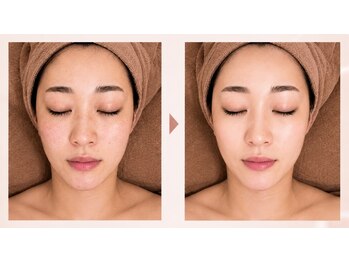 ミュエル(miel)の写真/美容皮膚科提携サロンの本格ケア♪白玉スノーピールや水光肌育で憧れのツヤ肌を目指して◎