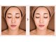 ミュエル(miel)の写真/美容皮膚科提携サロンの本格ケア♪白玉スノーピールや水光肌育で憧れのツヤ肌を目指して◎