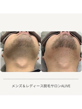 アライブ(ALIVE)/メンズ脱毛も大好評♪
