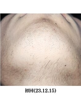 レイ(R.E.I)/【脱毛ビフォー】あご・首