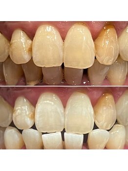 エピシアドットエヌ(epicia.N)/ホワイトニング2回