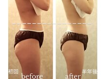 バービーホリック(barbie holic)/１３０分コース 初回/半年後比較