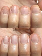 マリーロール 梅田店(Marie Laure)/深爪矯正/自爪育成/自爪風