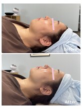 おおむら鍼灸接骨院/フェイシャル Before＆After