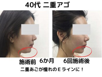 エンジェルエッグ/◆二重あごもスッキリ！