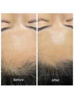 まっさ鍼灸整骨院 京王堀之内院/カーボキシー炭酸パック