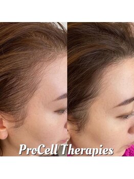 アイスブルー(Ice blue)/プロセルセラピーズBefore/After