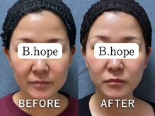 ビーホープ(B.hope)/ホワイトスノーピール4回の変化
