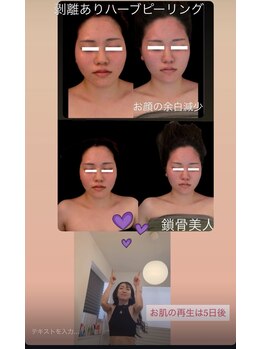 ジーニー(Genie)/剥離ありハーブピーリング
