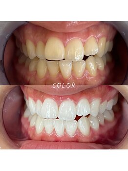 カラー(COLOR)/セルフホワイトニング効果☆