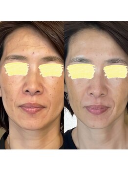 たかはし治療院/美容鍼 1回