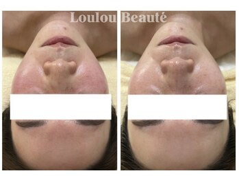 ルルボーテ(Loulou Beaute)/クリスティーナ/アンストレス