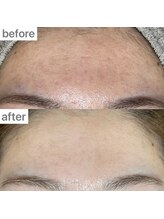 ユイット ルッカ(Huit Lucca)/ララピール×アクアダーマ