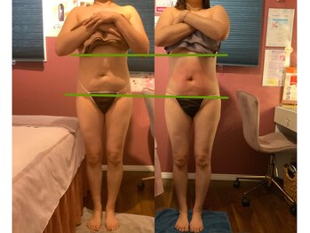 レイ 本厚木(Rei)/脂肪冷却お腹ビフォーアフター