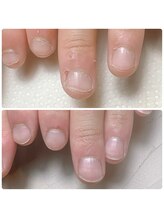 スマイルニコ(smile nico)/中学生の自爪育成