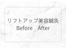 オリナ(olina)/ リフトアップ鍼灸Before &After