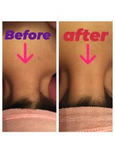 アンリール 旭川店(Anrire)/脱毛でご来店のお客様です！