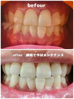 ワイズサロン(Y's salon)/ホワイトニング継続で!