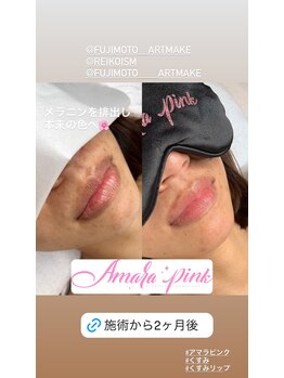 フジモトサロン 那覇おもろまち店(fujimotoサロン)/アマラピンク2ヵ月後の経過