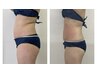 【SUMMERキャンペーン】脂肪冷却《お腹集中》キャビ×EMS付