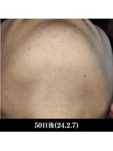 レイ(R.E.I)/【脱毛アフター】あご・首