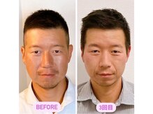 小顔22 ボルティ 赤坂支店(Bolty)/40代：小顔シンメトリー（3回）