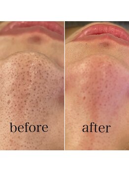 ブルームーン(Blue Moon)/ハイドラ毛穴洗浄 1回施術