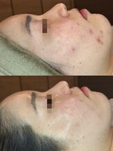 フルール ニコ(Fleur Nico)/3回のBeforeAfter